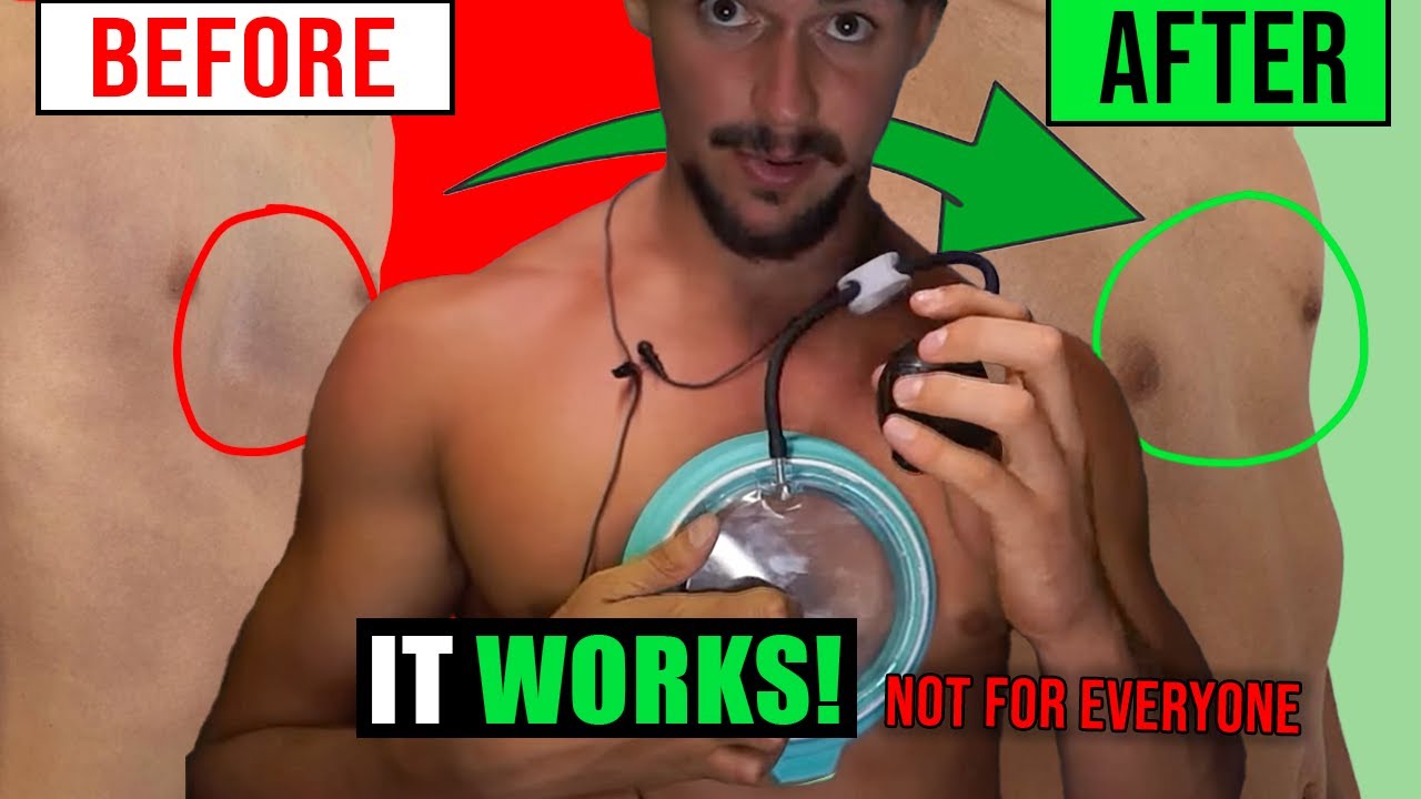 Does the Vacuum Bell Actually Fix Pectus? (Expert Reveals Everything)