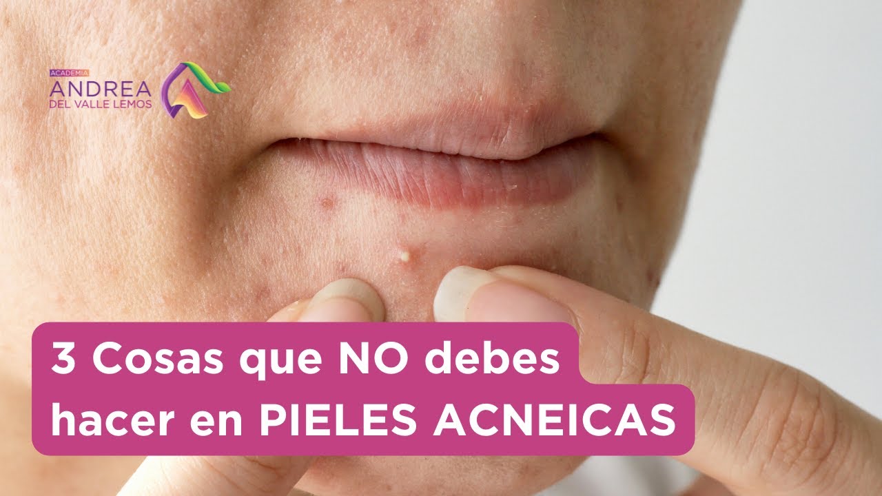 3 cosas que NO DEBES HACER al trabajar en pieles acneicas
