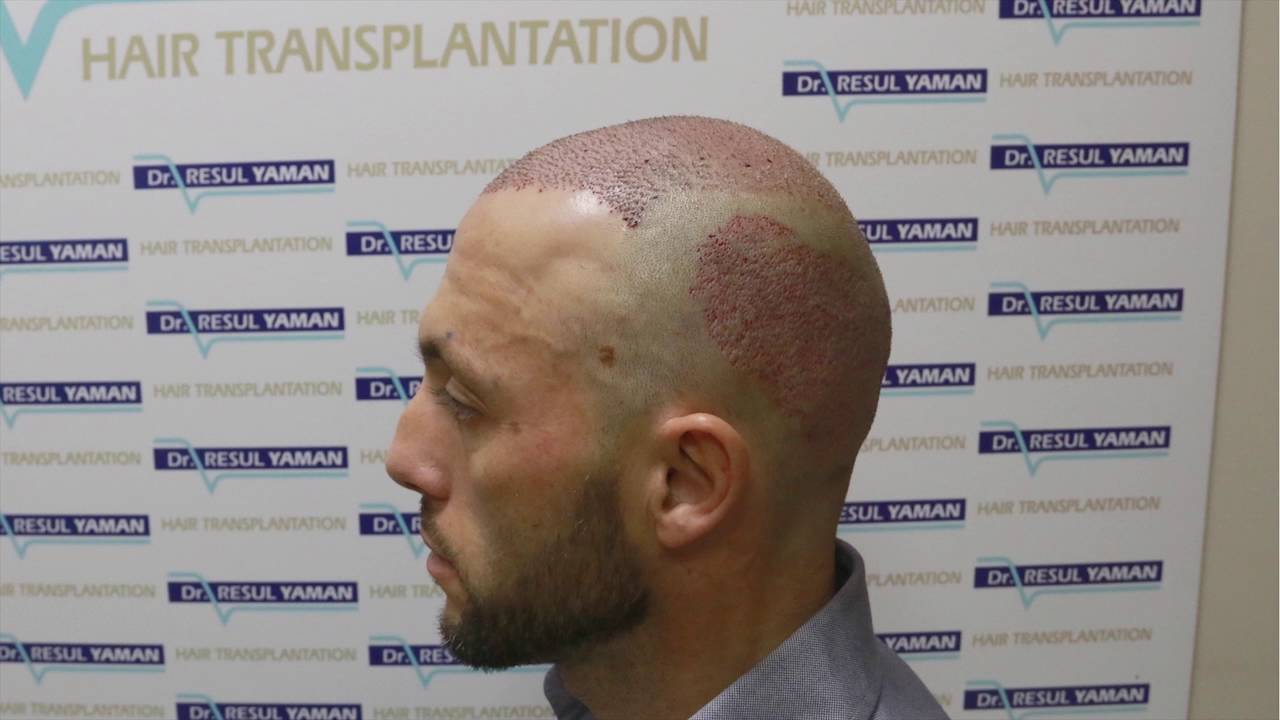 Dr Resul Yaman Hair Clinic - Patient Resut