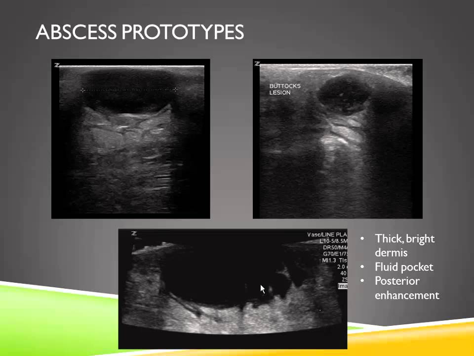 Ultrasound of Skin and Soft Tissue Infections