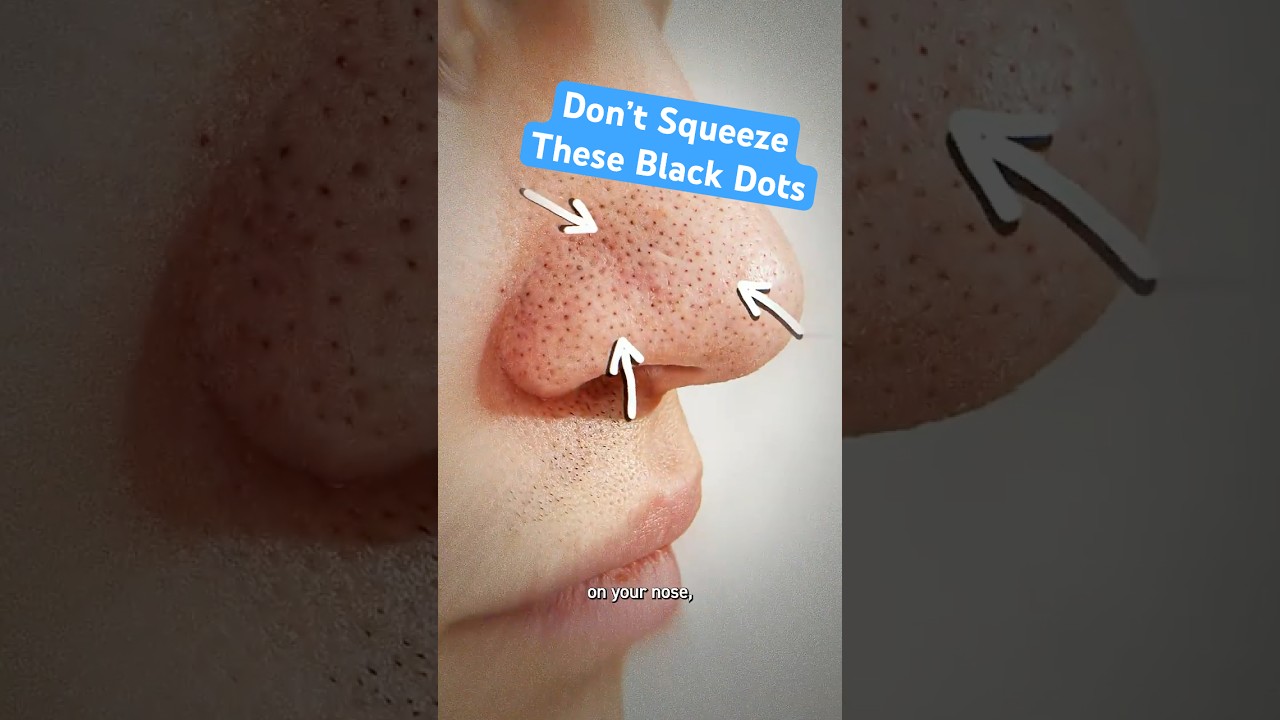 Don&rsquo;t Squeeze Those Black Dots on Your Nose