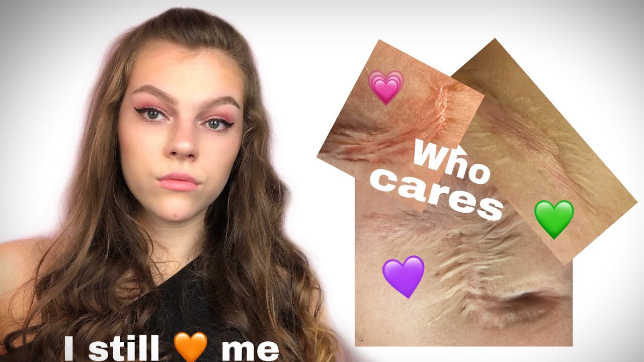 HOW TO LOVE YOURSELF WITH SCARS ?! | My Scar Story
