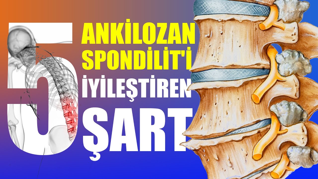 Ankilozan Spondilit'i İyileştiren 5 Şart #iyileş #ankilozan
