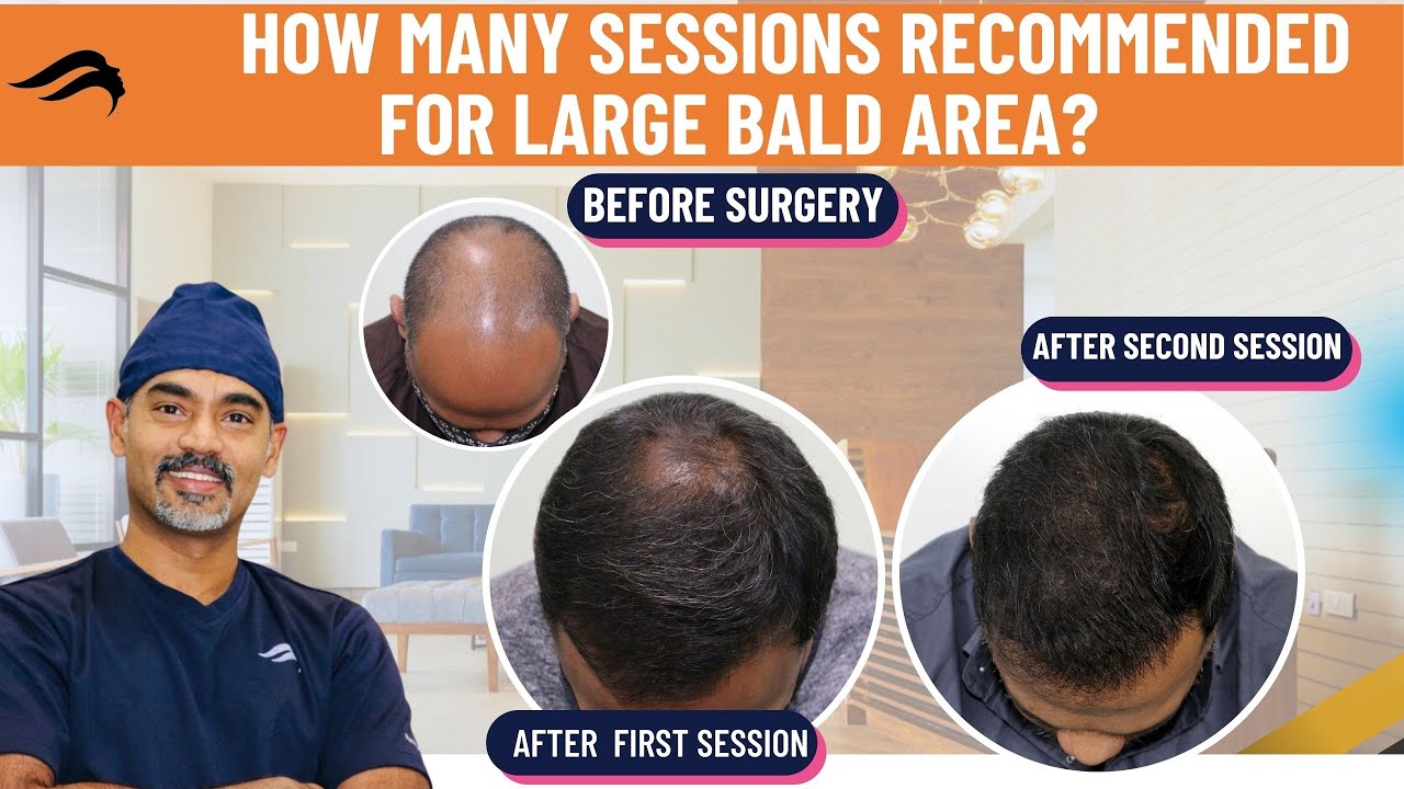 Hair Transplant In Chennai | Best Clinic Surgeon Results & Cost Of Hair Transplant Of Chennai
