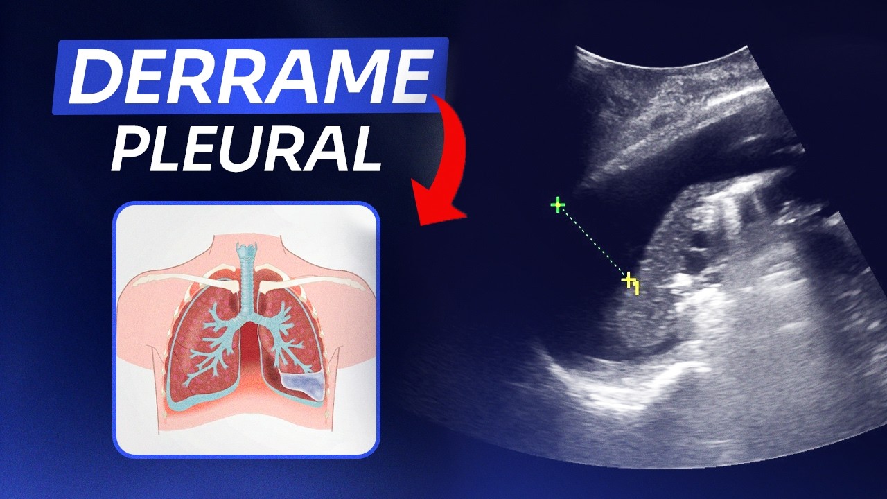 Como conduzir exame de derrame pleural no Ultrassom | Escola de Ultrassom