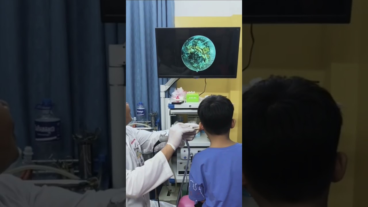 Deep Earwax Extraction with Endoscope View! 🔬👂 #InsideEar #EarwaxRemoval