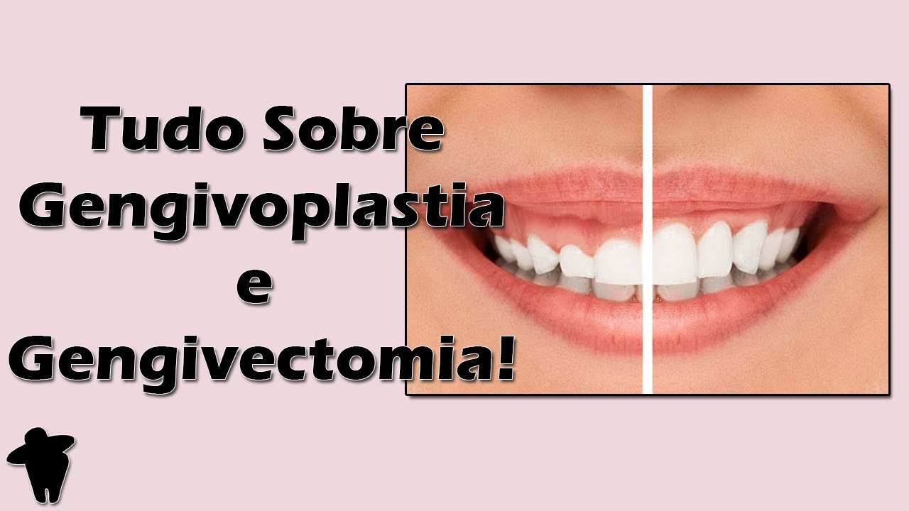 Aula de Periodontia - Tudo Sobre Gengivoplastia e Gengivectomia - Indicações e Passo a Passo