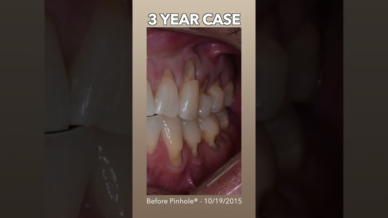 Common Cases that Periodontist sees frequently treated with Chao Pinhole&reg; Surgical Technique