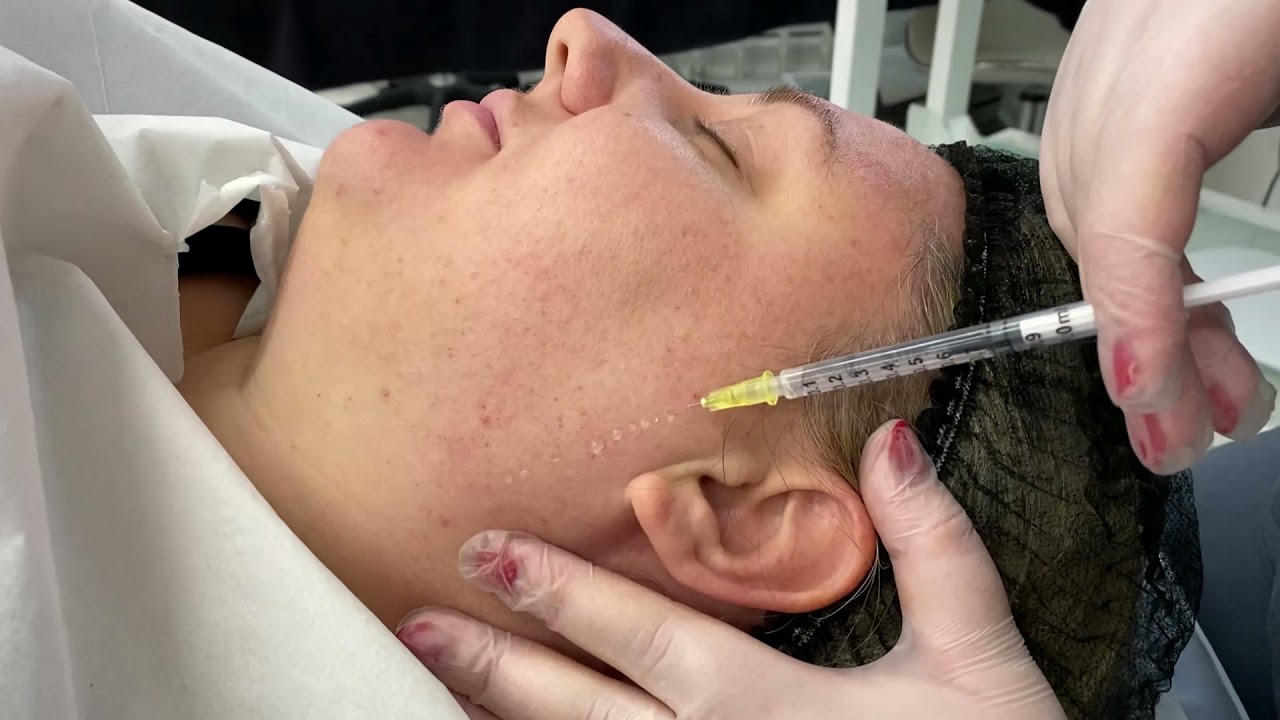 Nappage Mesotherapy