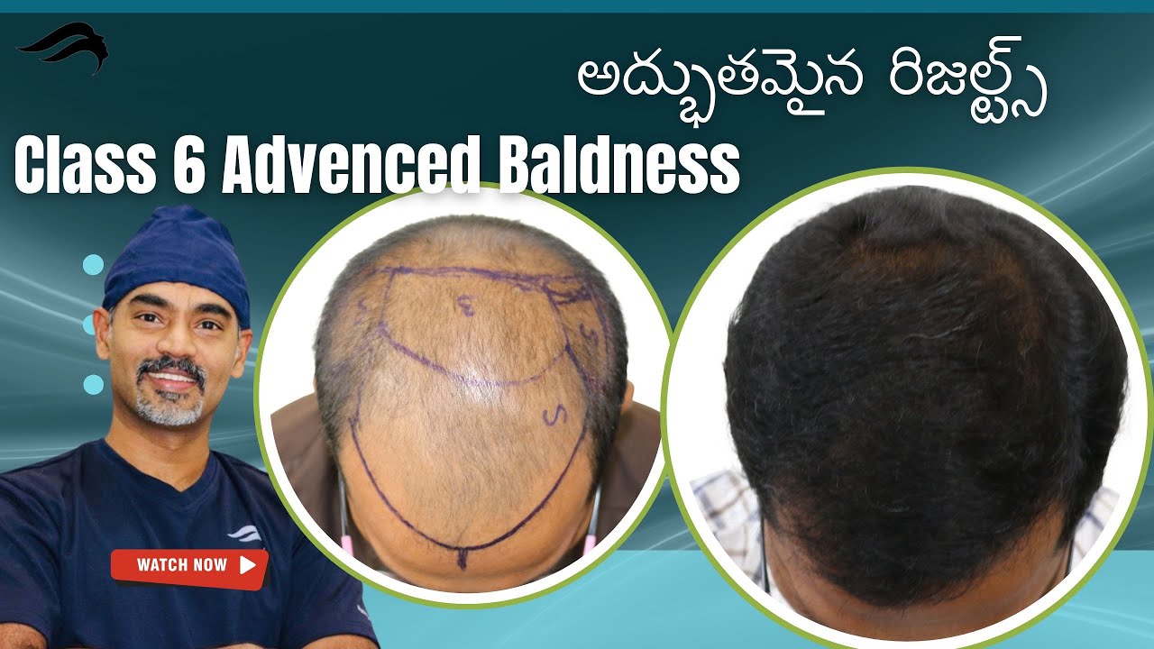 Hair Transplant In Hyderabad | Best Clinic Results & Doctor Of Hair Transplant Surgery In Hyderabad