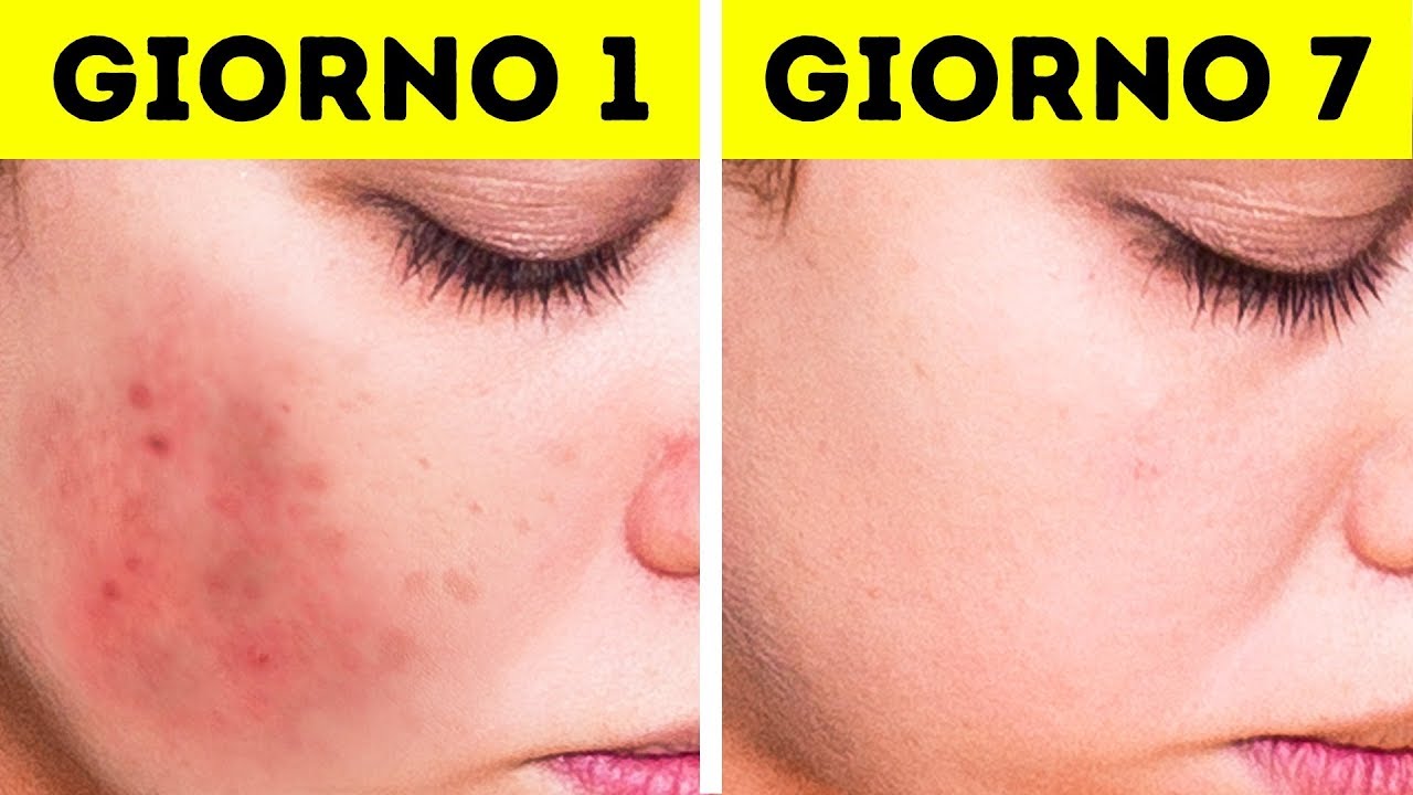 Trucchi per Rimuovere le Macchie del Viso in Modo Facile e Naturale