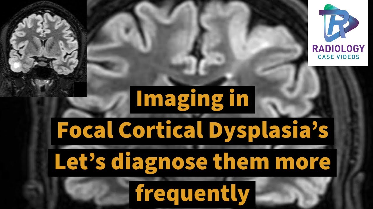 Imaging in focal cortical dysplasia's:Let's diagnose them confidently#Transmantle sign#Epilepsy MRI#