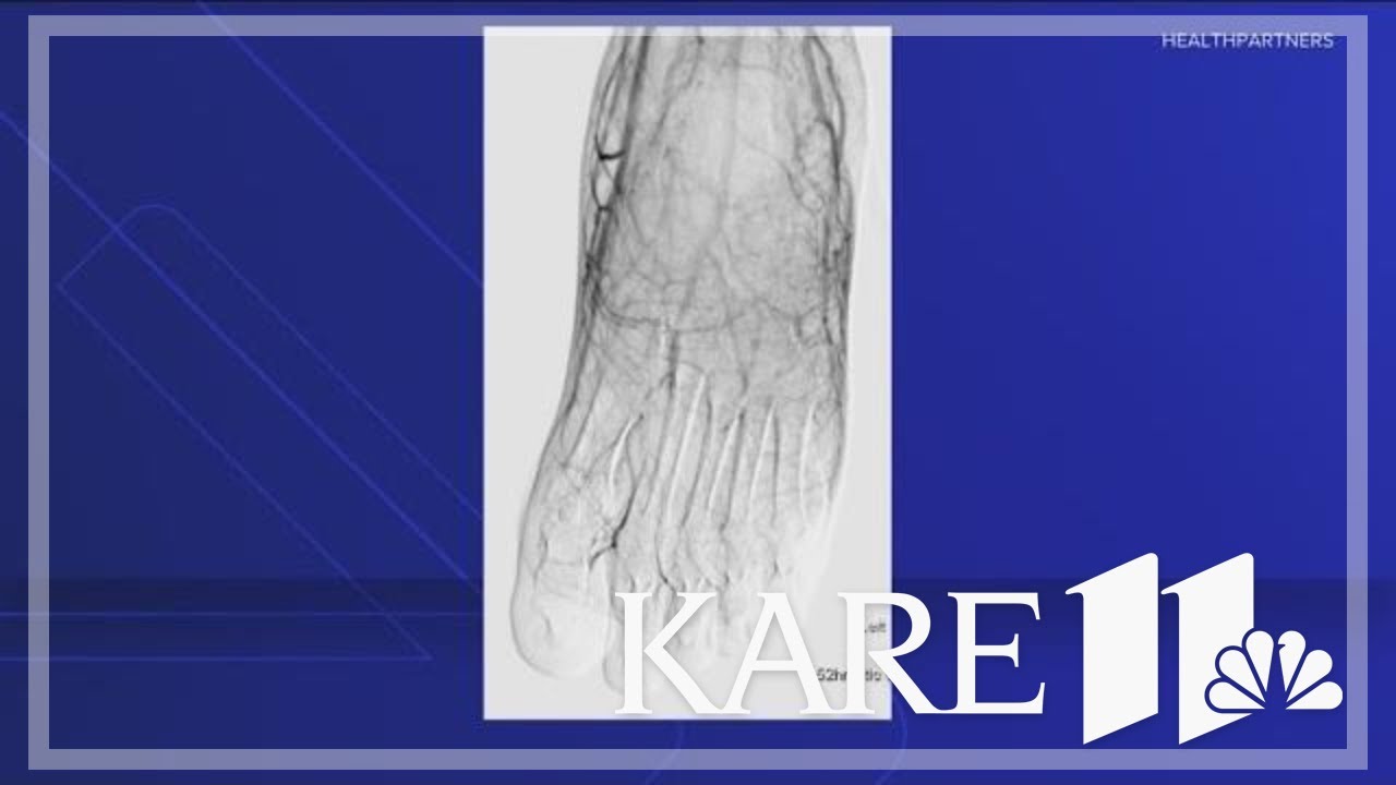 FDA approves first frostbite treatment