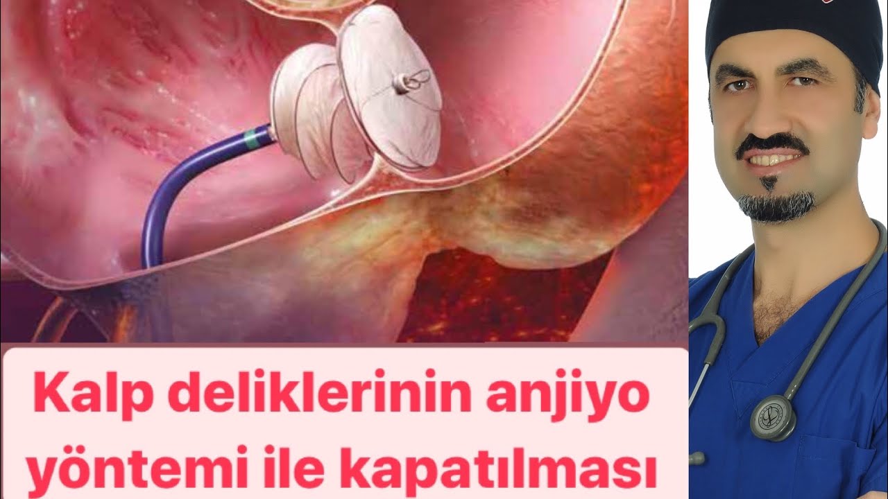 ASD , VSD ve DİĞER DOĞUMSAL KALP DELİKLERİNİN TEDAVİSİ (HASTA KILAVUZU) - PROF DR AHMET KARABULUT