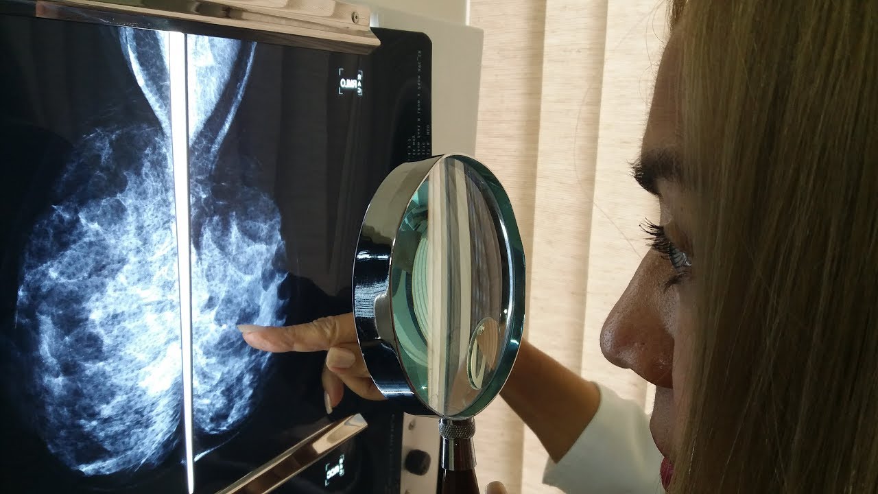 😱 Calcificação Na Mama Quando Pode Ser Benigna ou Câncer? 🔝 - Dra. Vanderléa Coelho 😘