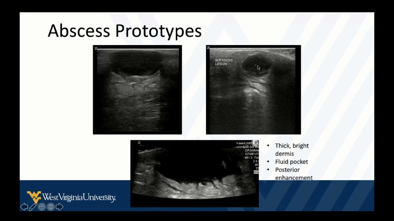 POCUS in Skin and Soft Tissue Infections 1 - Intro and Key Findings