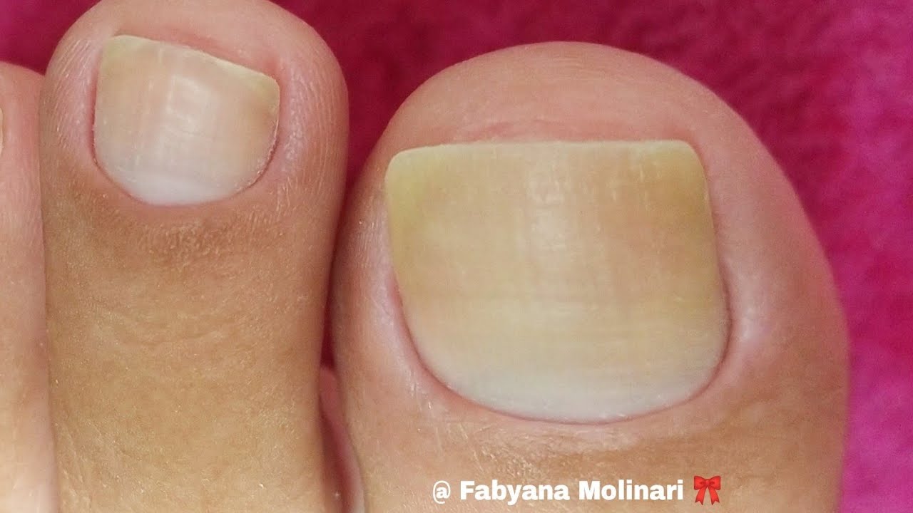 cutilagem ressecada e mega grudada nas unhas dos pés  - vejam !!! alicate 722
