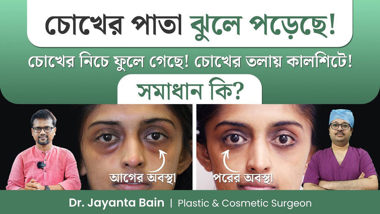 চোখের পাতা নিচে নেমে গেলে করনীয় কী? চোখের তলার কালশিটে ও ফোলাভাব দূর করার উপায় | Dr. Jayanta Bain