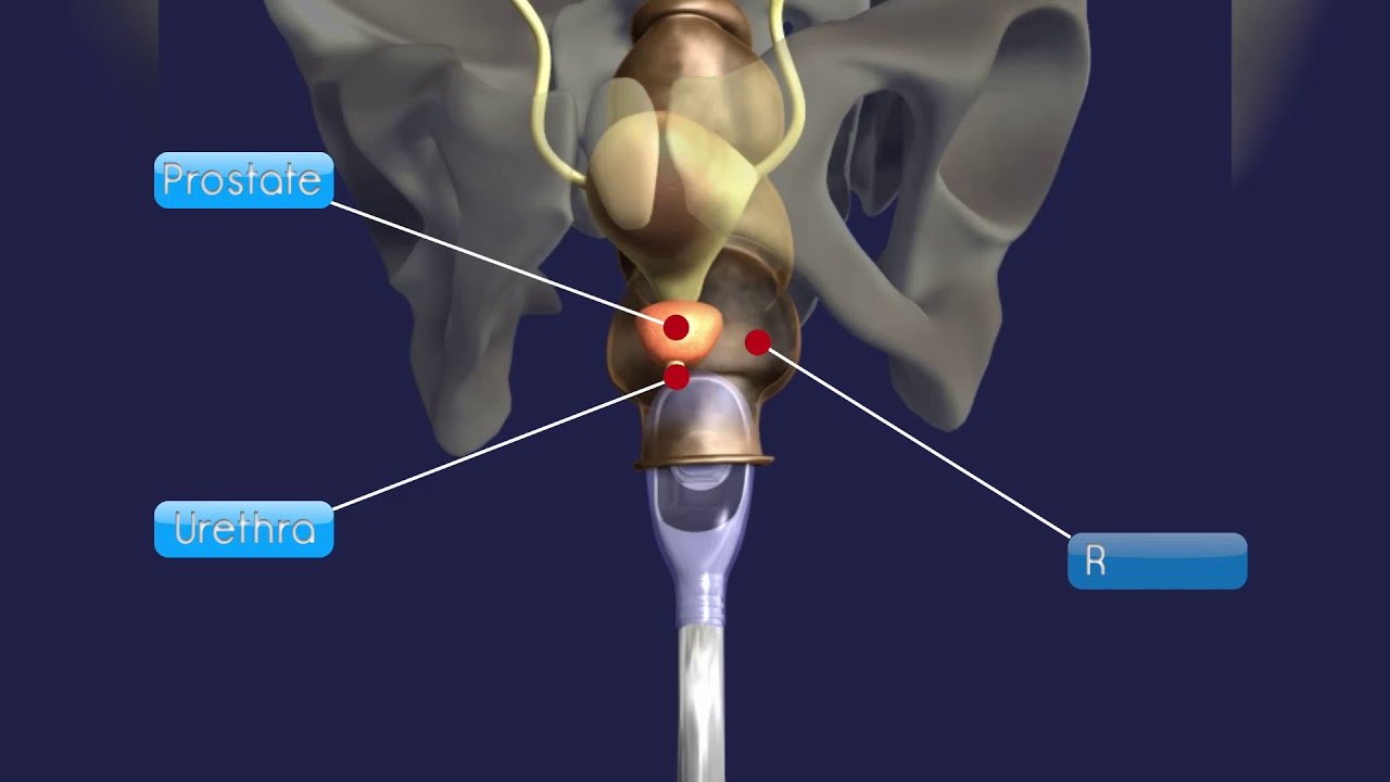 Focal One HIFU for prostate tissue ablation (US)