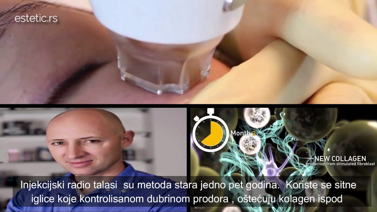 Dr Dinko Kaliterna: Podmlađivanje lica  injekcijskim radio talasima