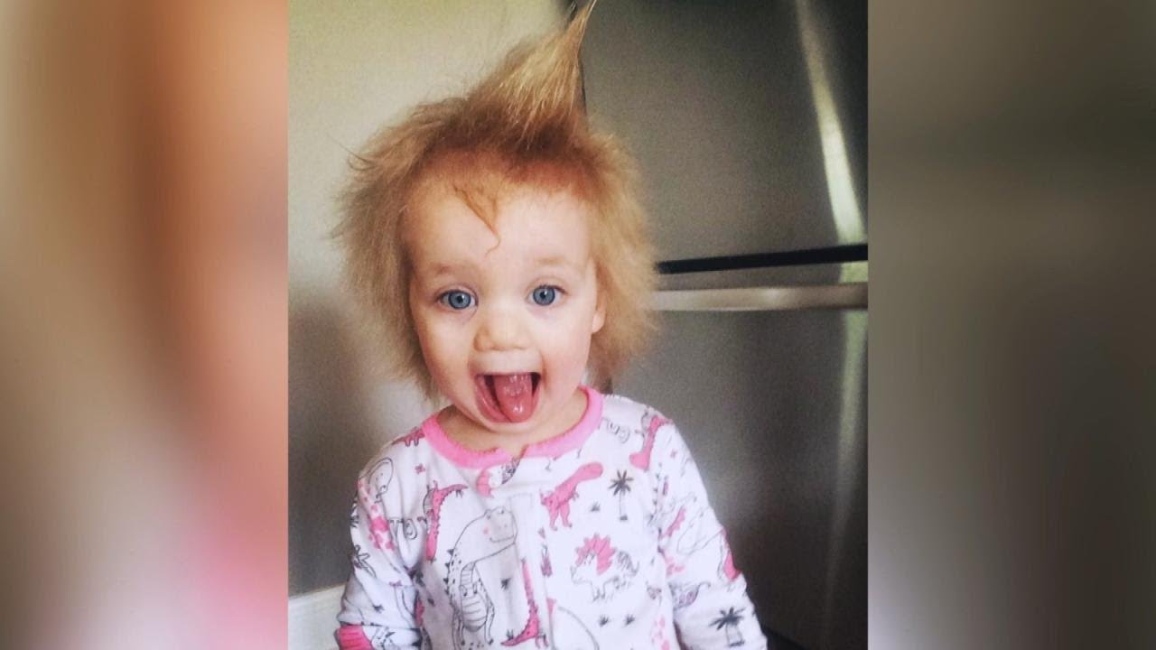 Child's Uncombable Hair Syndrome Explained!