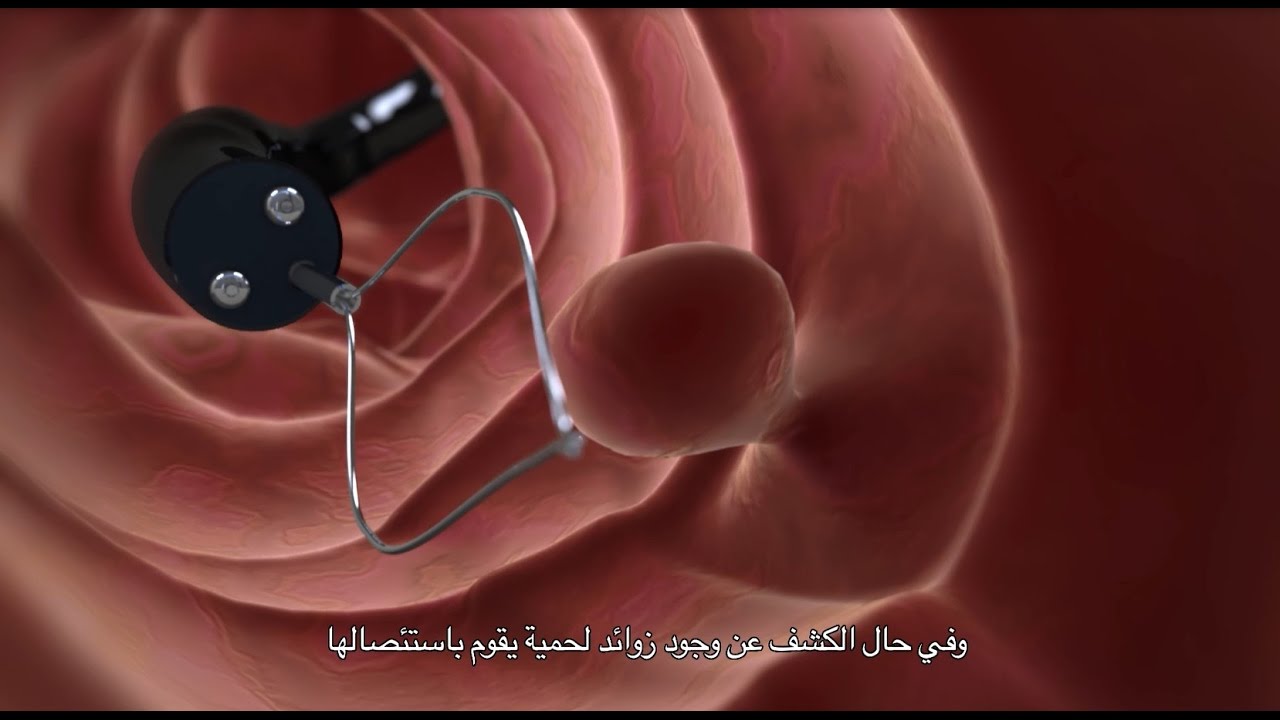 فحص القولون