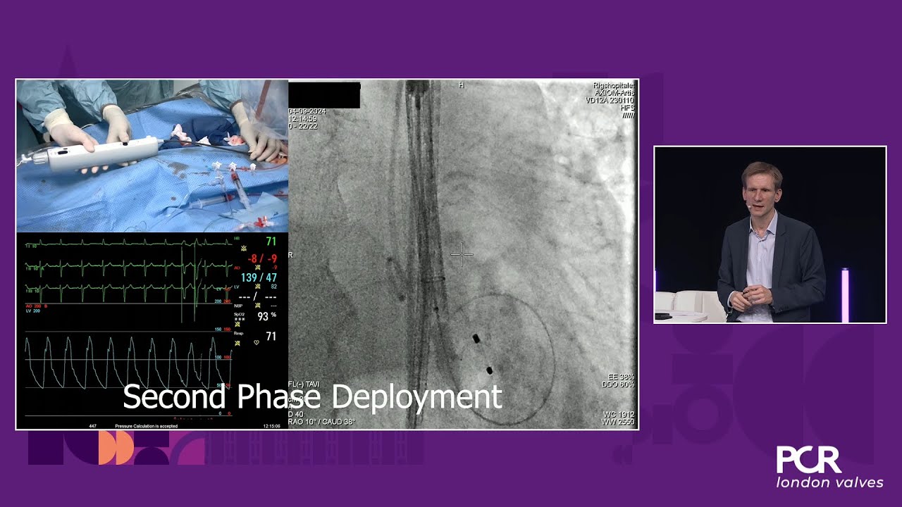 Optimising TAVI for bicuspid aortic stenosis: experience with a novel self-expanding system