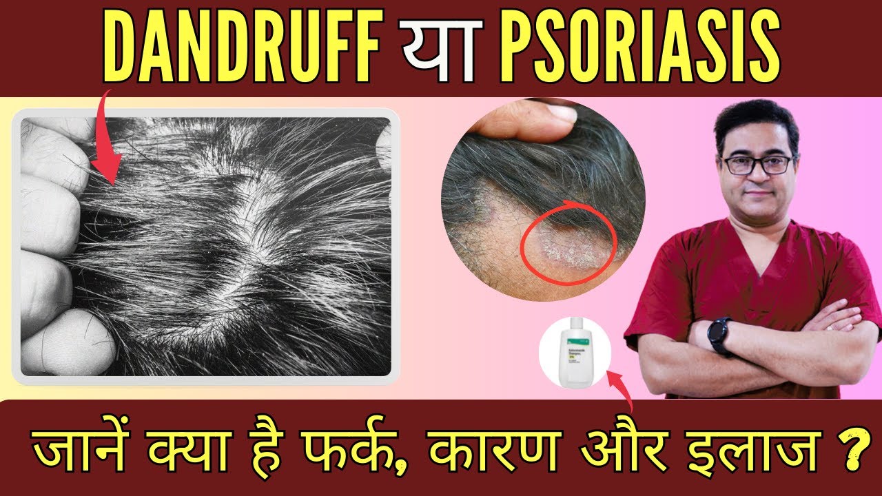 Dandruff Vs Scalp Psoriasis | डैंड्रफ Vs सोरायसिस  | Health Mantra With Dr Vikram