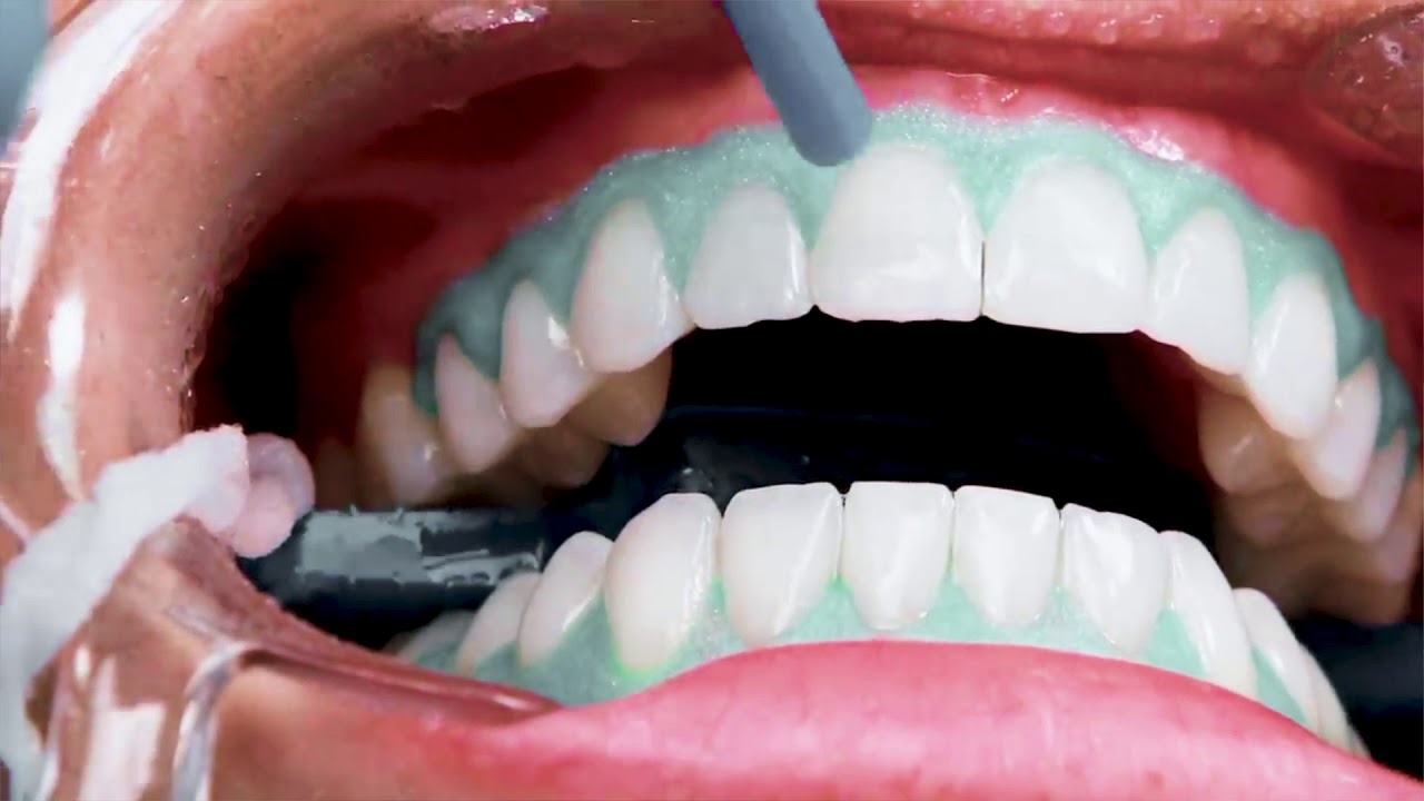 Limpieza y Blanqueamiento Dental ▷ Centro Dental Querétaro