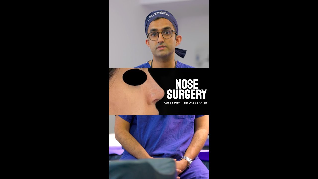 Nose Surgery Transformation | Before & After Case Study 🔎