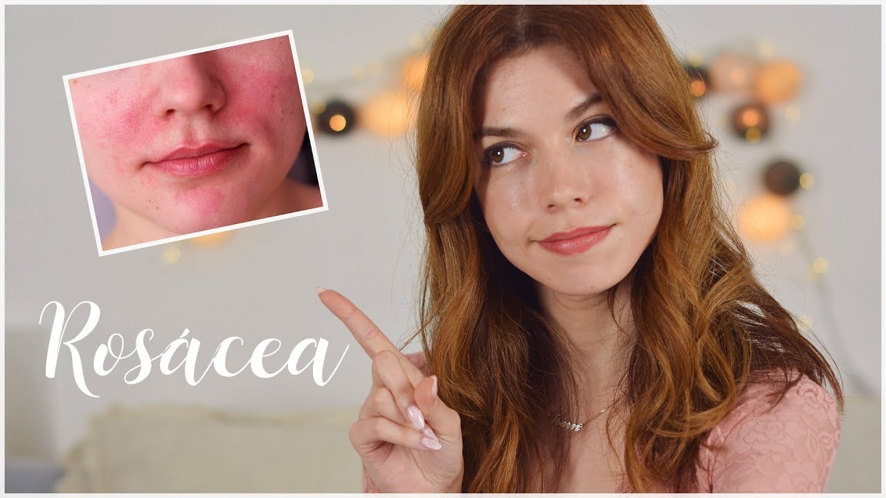 ROSÁCEA | Cómo controlarla y productos recomendados