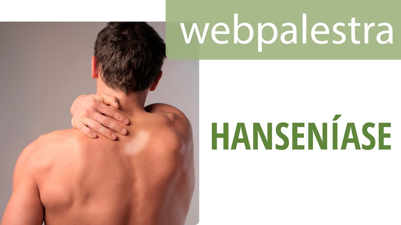 Webpalestra - Hanseníase na Atenção Básica: avanços e desafios