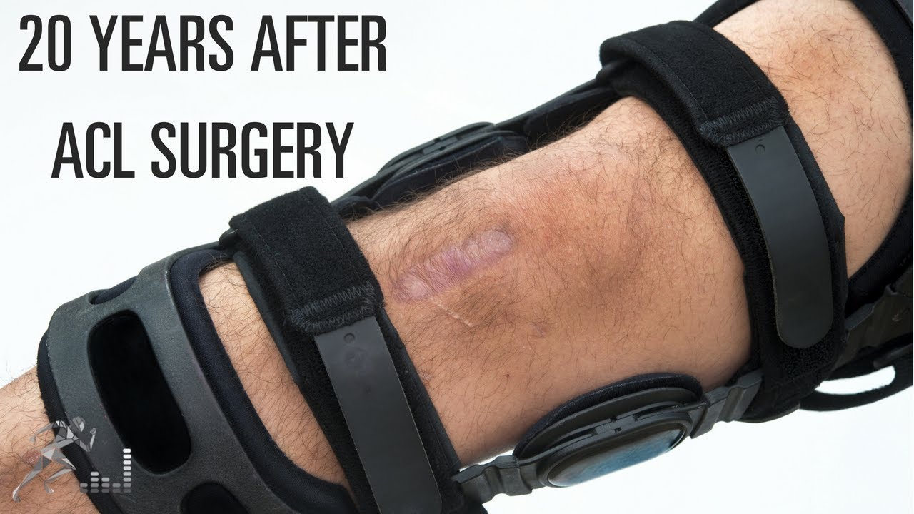 What is the future of my knee 20 years after ACL surgery?