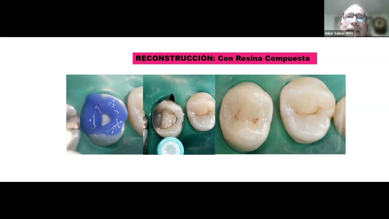 RECONSTRUCCIÓN DE DIENTES ENDODONCIADOS, CEMENTACIÓN ADHESION