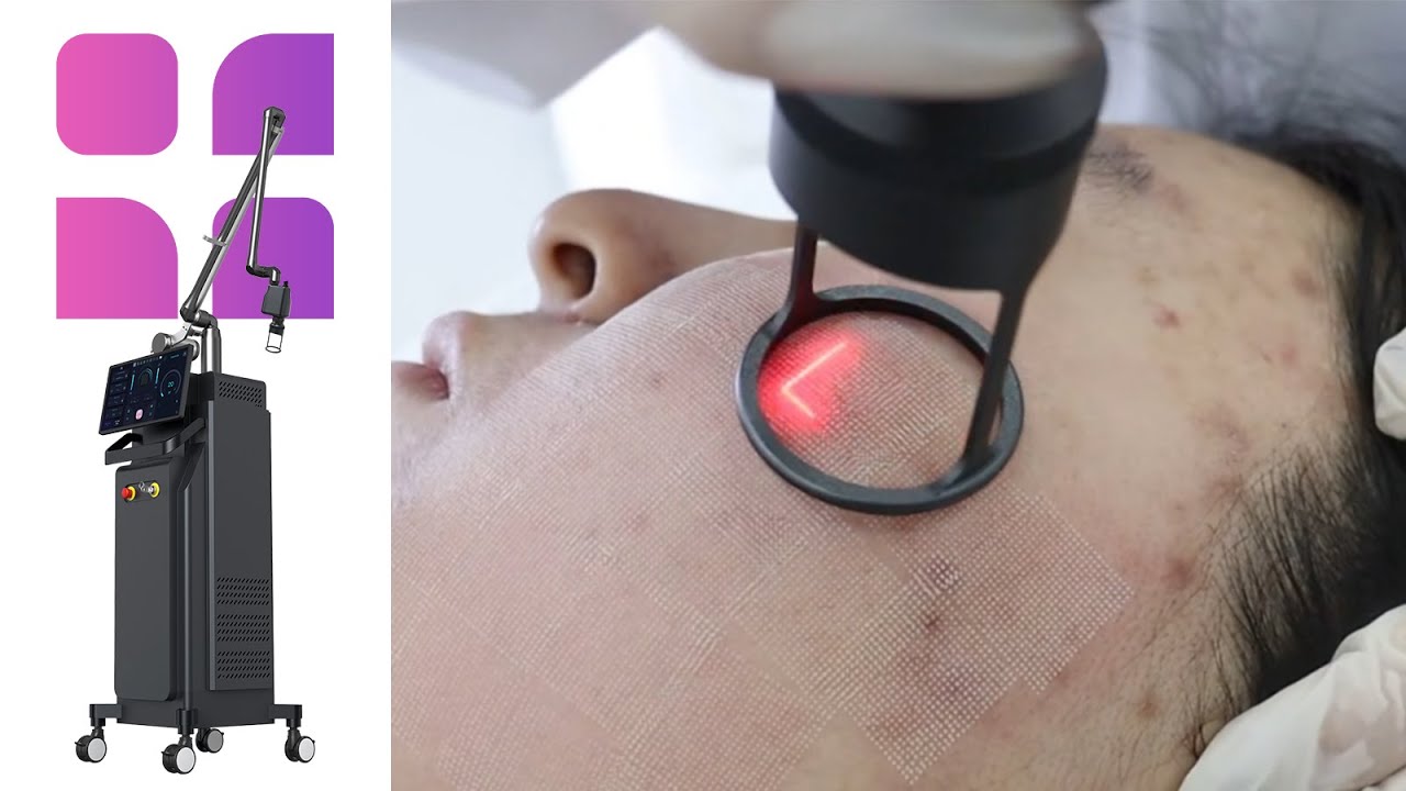 How to Treat Acne Scars & Large Pores with Professional Fractional CO2 Laser