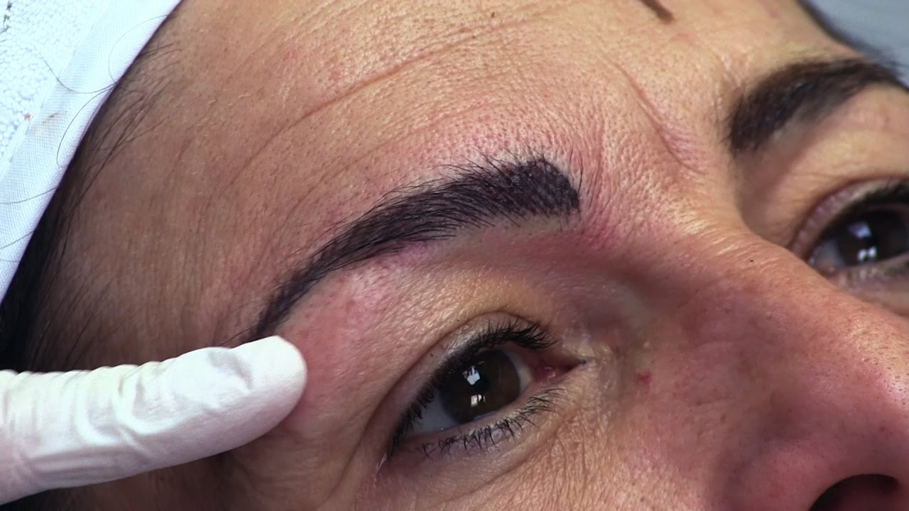 Dermo-pigmentation d'un sourcil [DERMALYA]