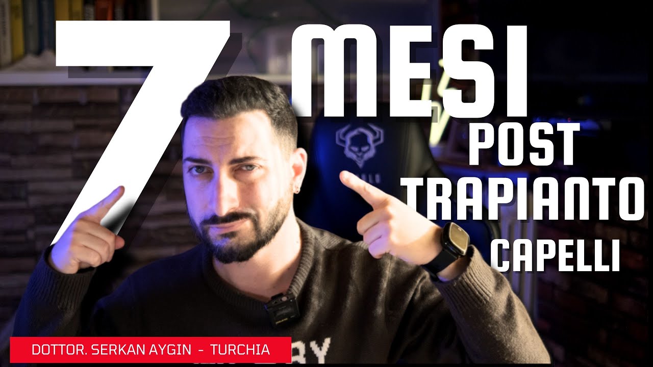 7 mesi dal TRAPIANTO di CAPELLI in Turchia -  Finasteride, Minoxidil, Biotina - CHIAREZZA