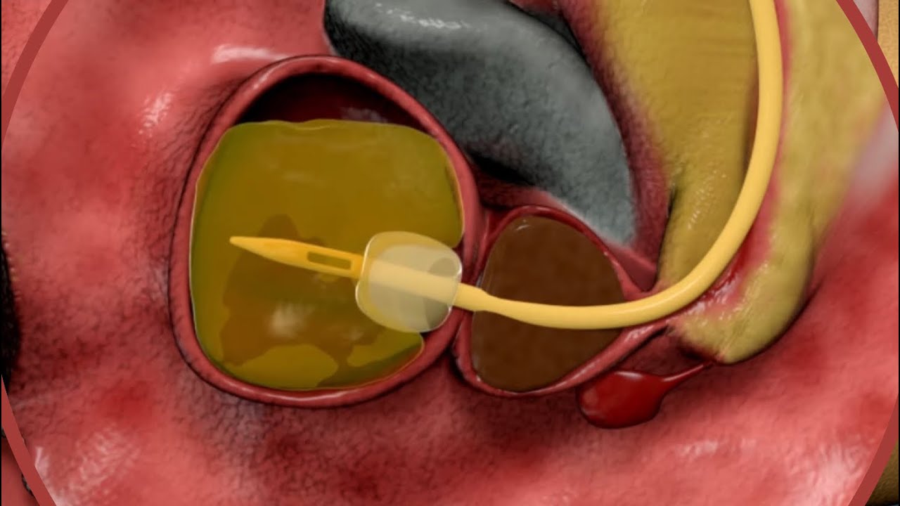 male foley catheter! Dandelion medical animation|