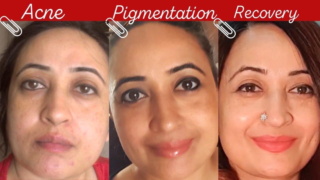How I CLEARED Acne- Skin care Products That Actually work! Get Rid Of Acne, Scars, Pigmentation