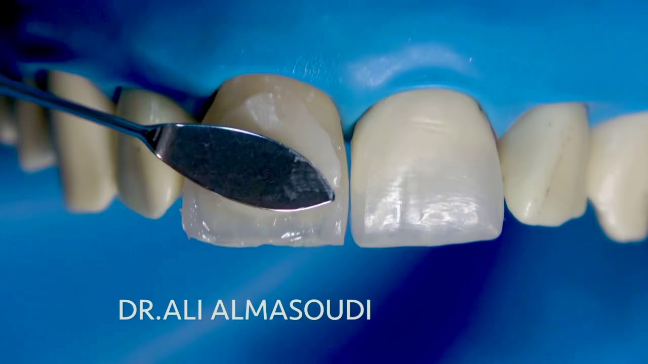 Direct composite with SOLO Anterior