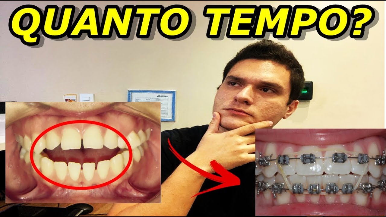 QUANTO TEMPO DEMORA PARA CORRIGIR A MORDIDA ABERTA COM APARELHO ORTÔNTICO?
