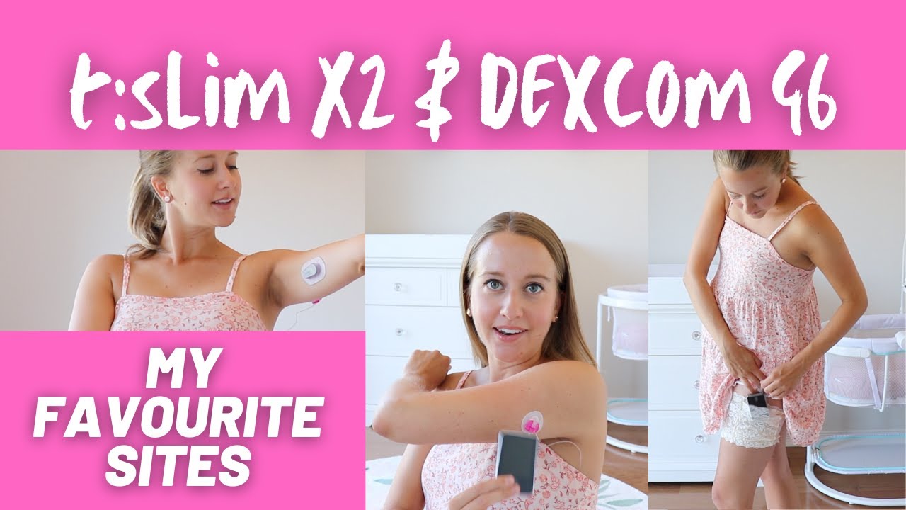 мои любимые сайты с инсулиновой помпой t:slim X2 и Dexcom G6 во время беременности