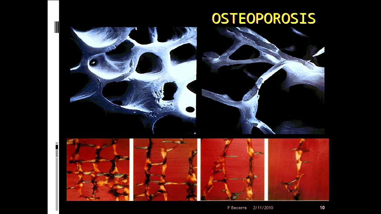 Osteoporosis - Curso Residentado Médico | Reumatología
