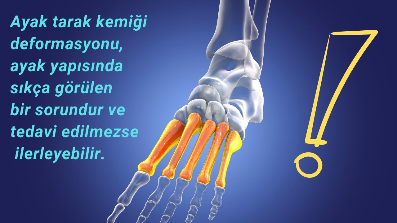 Ayak Tarak Kemiği Deformasyonu (çıkığı)  Nasıl Düzeltilebilir? (2024)? | Doç.Dr. Kaya Akan