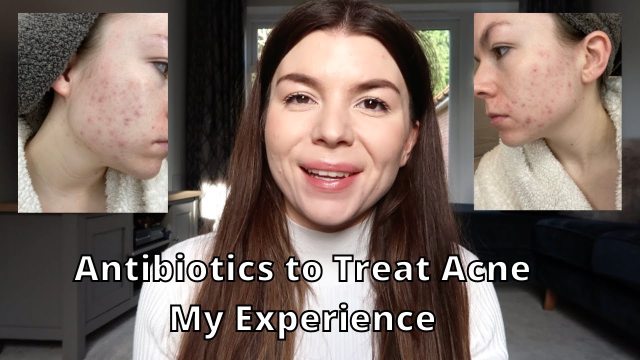 My Experience on Antibiotics for Acne (erythromycin and doxycycline) Did They Work? My Acne Journey
