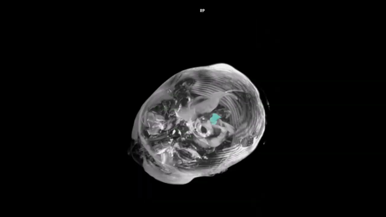 Tumor volumetric analysis guide: Horos software