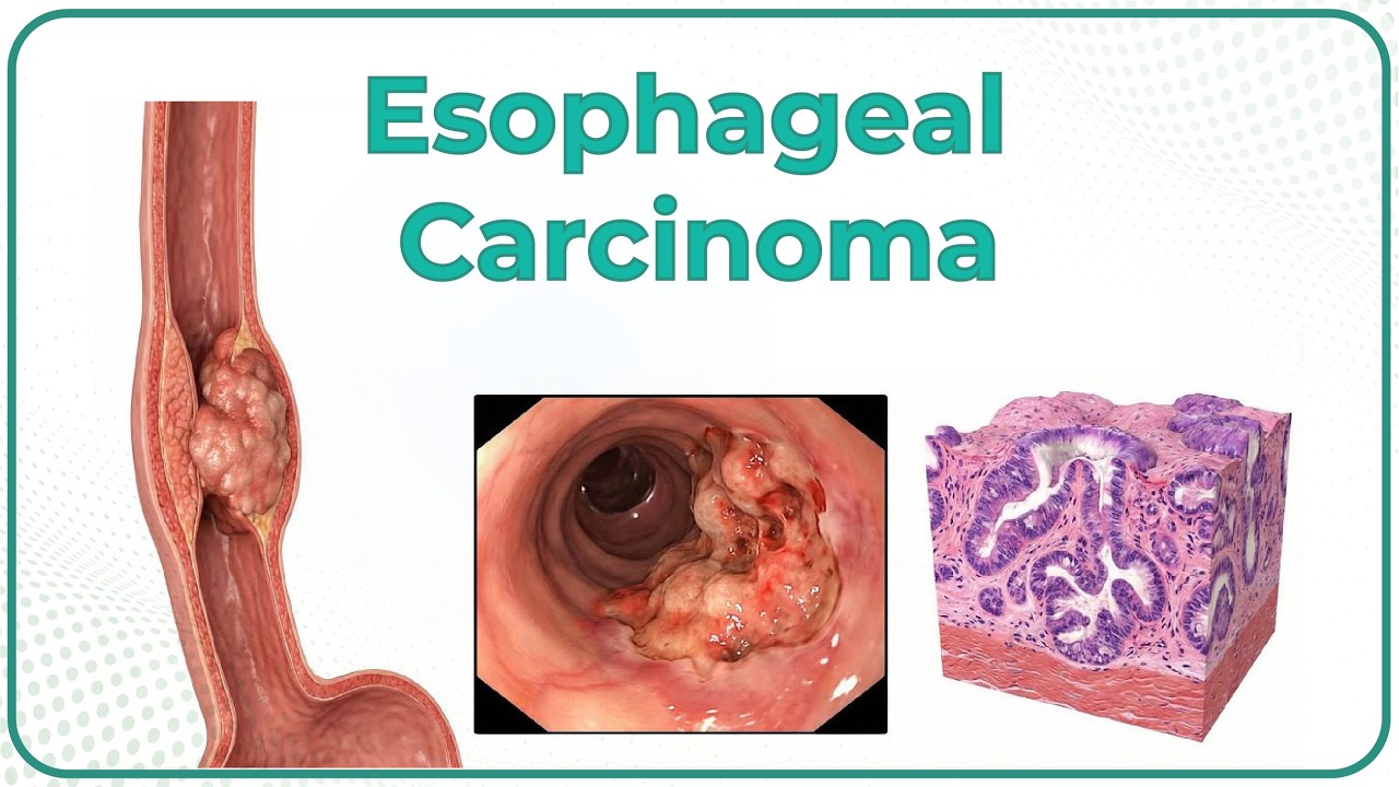 Esophageal Carcinoma Made Easy | Etiology, Features, Diagnosis & Treatment | USMLE Step 2 CK