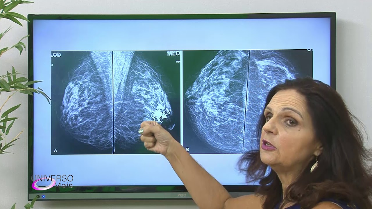 CÂNCER DE MAMA - PREVENÇÃO
