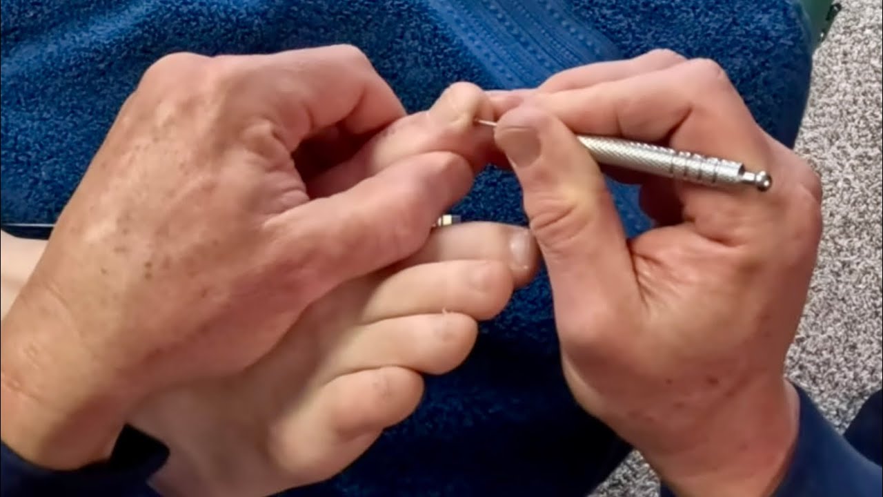 Intense Foot Massage Using Acupressure Tools to Loosen Roots of Tension. Rock First Session