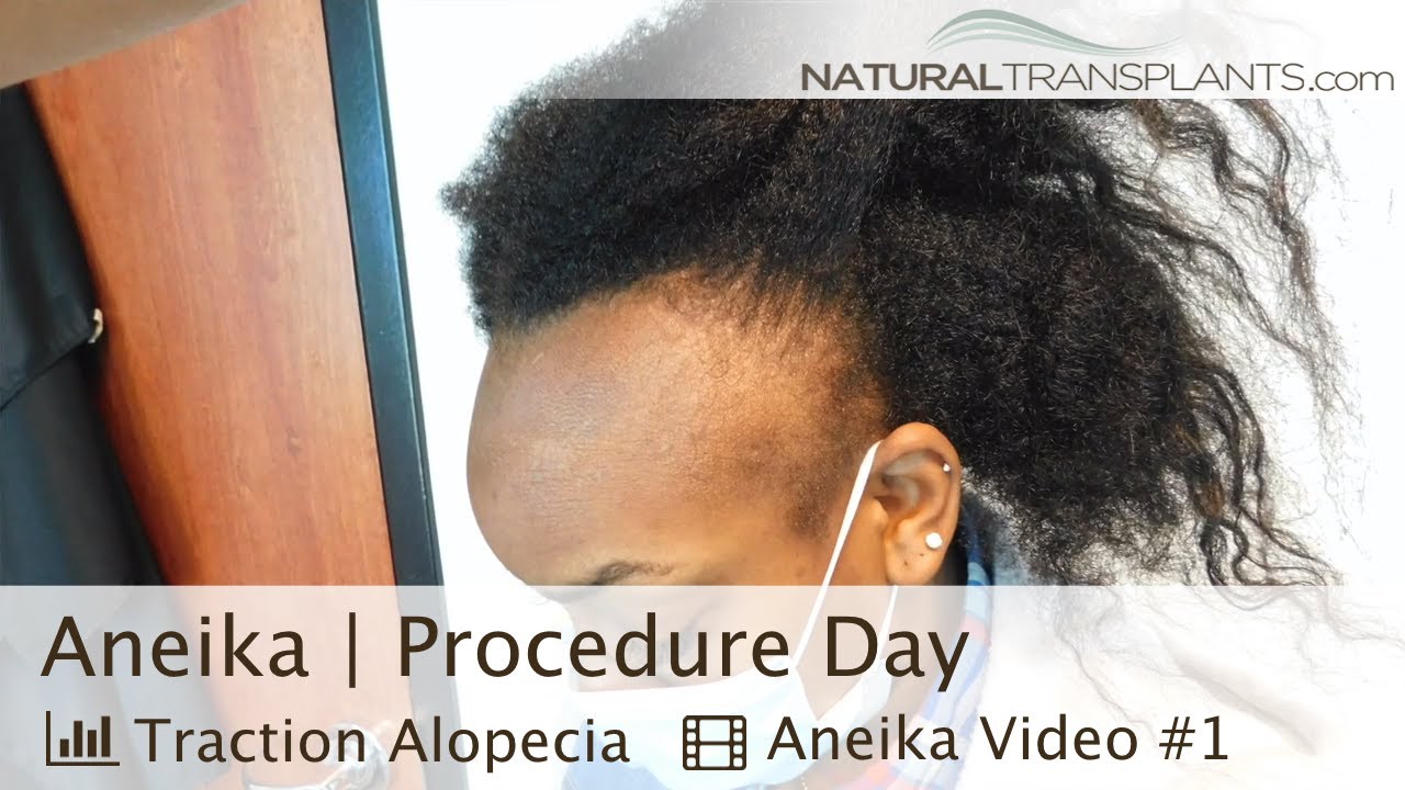 Hairline Transplant for Thinning Edges Procedure Day  | Dr Harold Siegel (Aneika)